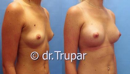 augmentace Trupar 11 0002
