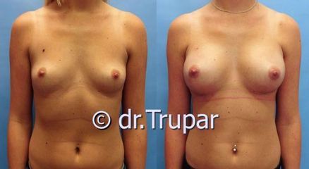 augmentace Trupar 11 0003