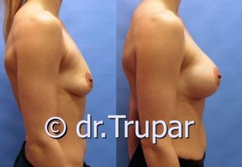 augmentace Trupar 12 0001