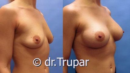augmentace Trupar 12 0002