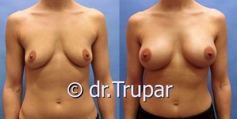 augmentace Trupar 12 0003