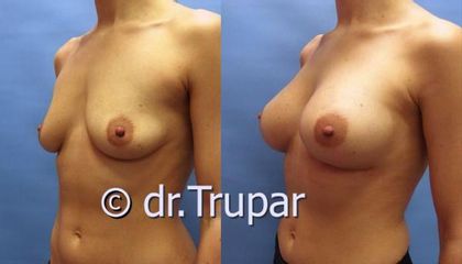 augmentace Trupar 12 0004