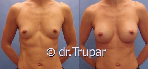 augmentace Trupar 13 0001