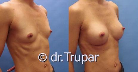 augmentace Trupar 13 0002