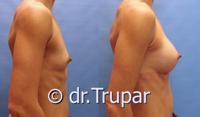 augmentace Trupar 13 0004
