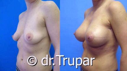augmentace Trupar 14 0001