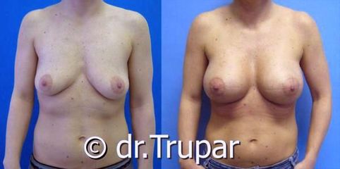augmentace Trupar 14 0002
