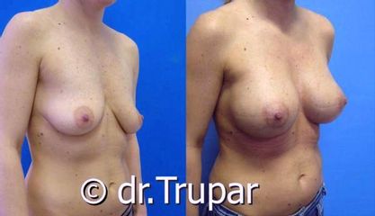 augmentace Trupar 14 0003