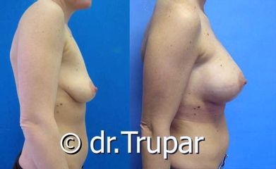 augmentace Trupar 14 0004