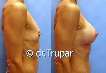 augmentace Trupar 15 0001