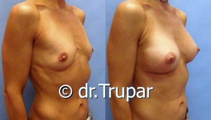 augmentace Trupar 15 0002