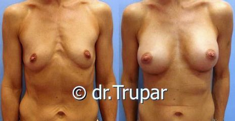 augmentace Trupar 15 0003
