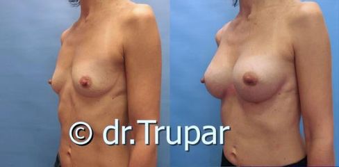 augmentace Trupar 16 0001