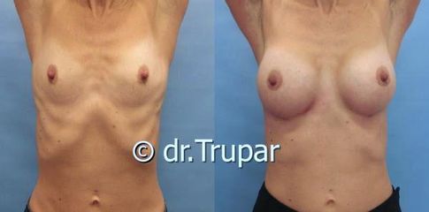 augmentace Trupar 16 0002