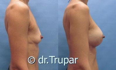 augmentace Trupar 16 0003