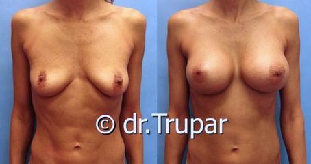 augmentace Trupar 17 0001