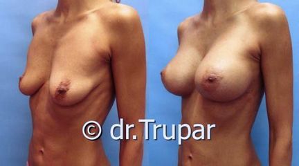 augmentace Trupar 17 0002
