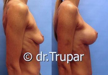 augmentace Trupar 17 0003