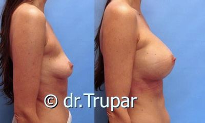 augmentace Trupar 18 0001