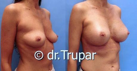 augmentace Trupar 18 0002