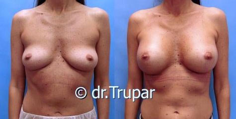 augmentace Trupar 18 0003