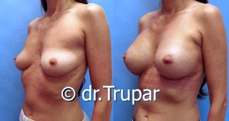augmentace Trupar 18 0004