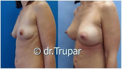 augmentace Trupar 19 0001