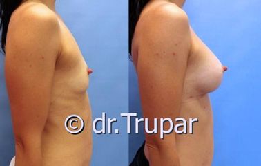 augmentace Trupar 20 0001