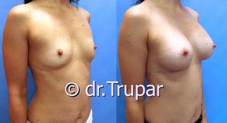 augmentace Trupar 20 0002