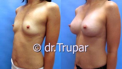 augmentace Trupar 20 0004