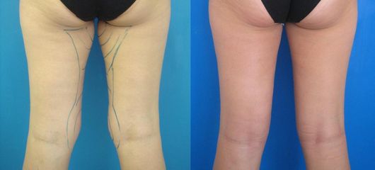 lipo vnitrni stkol DSC03152 kopie