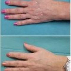 Hloubková hydratace hřbetů rukou