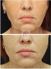 Facelift mezonitě