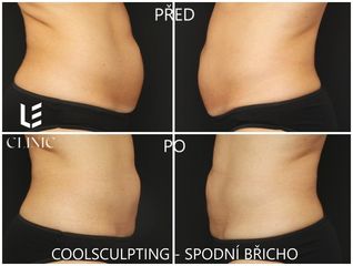 CoolSculpting - ošetření spodního břicha