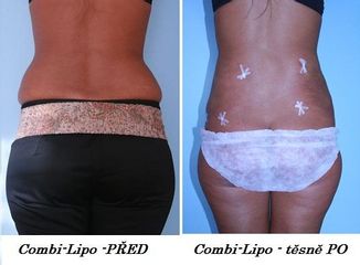 combi lipo   komplet