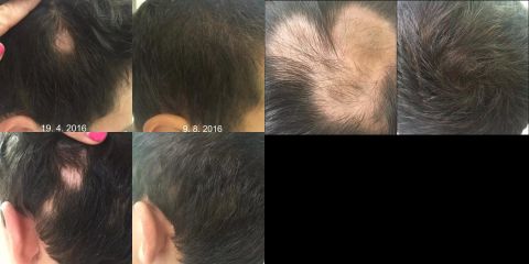 Léčba alopecie areáta