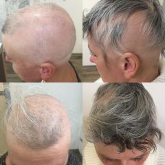 Léčba padání vlasů - CLINICAL HAIR&HEALTH Vlasové centrum a klinika zdraví