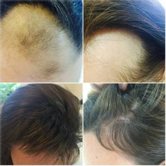 Alopecie - CLINICAL HAIR&HEALTH Vlasové centrum a klinika zdraví
