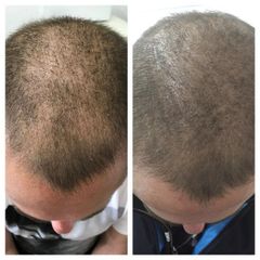 Transplantace vlasů - CLINICAL HAIR&HEALTH