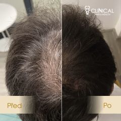 Transplantace vlasů - CLINICAL HAIR&HEALTH