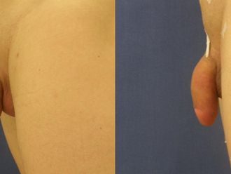 Zvětšení penisu před a po - 715747