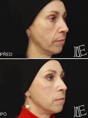 Niťový lifting APTOS + plastická operace očních víček - Lékařská Estetika