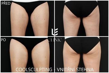 CoolSculpting -  vnitřní stehna, 2 měsíce po ošetření - LE CLINIC