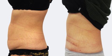 Abdominoplastika - MUDr. Peter Ondrejka - MEDICOM Clinic