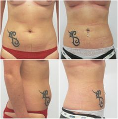 Liposukce - MUDr. Peter Ondrejka - MEDICOM Clinic
