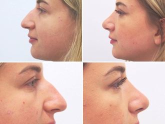 Rhinoplastika před a po - 853438