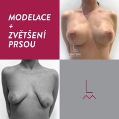 Modelace prsou - MUDr. Lubor Mrňa