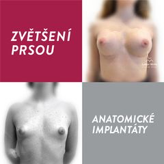 Zvětšení prsou - MUDr. Lubor Mrňa