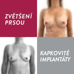 Zvětšení prsou - MUDr. Lubor Mrňa