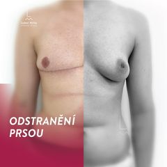 Mastektomie - MUDr. Lubor Mrňa